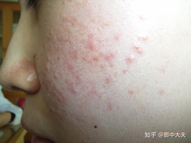 痤疮的诊断及治疗 - 知乎