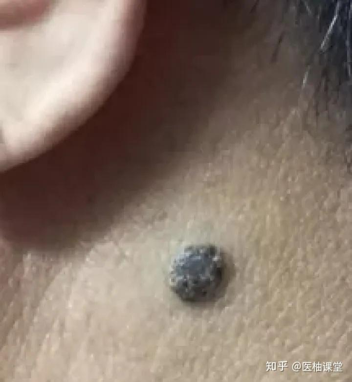 黑痣癌变， 从发病到去世不到两个月！这些痣千万要小心！ - 知乎