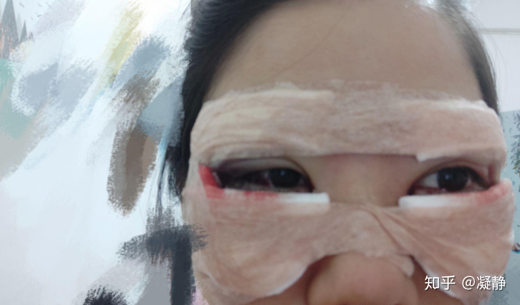 怎么消除眼睛充血 v2-0cfe5fcdc6a575e306cc95337e0dff80_r.jpg