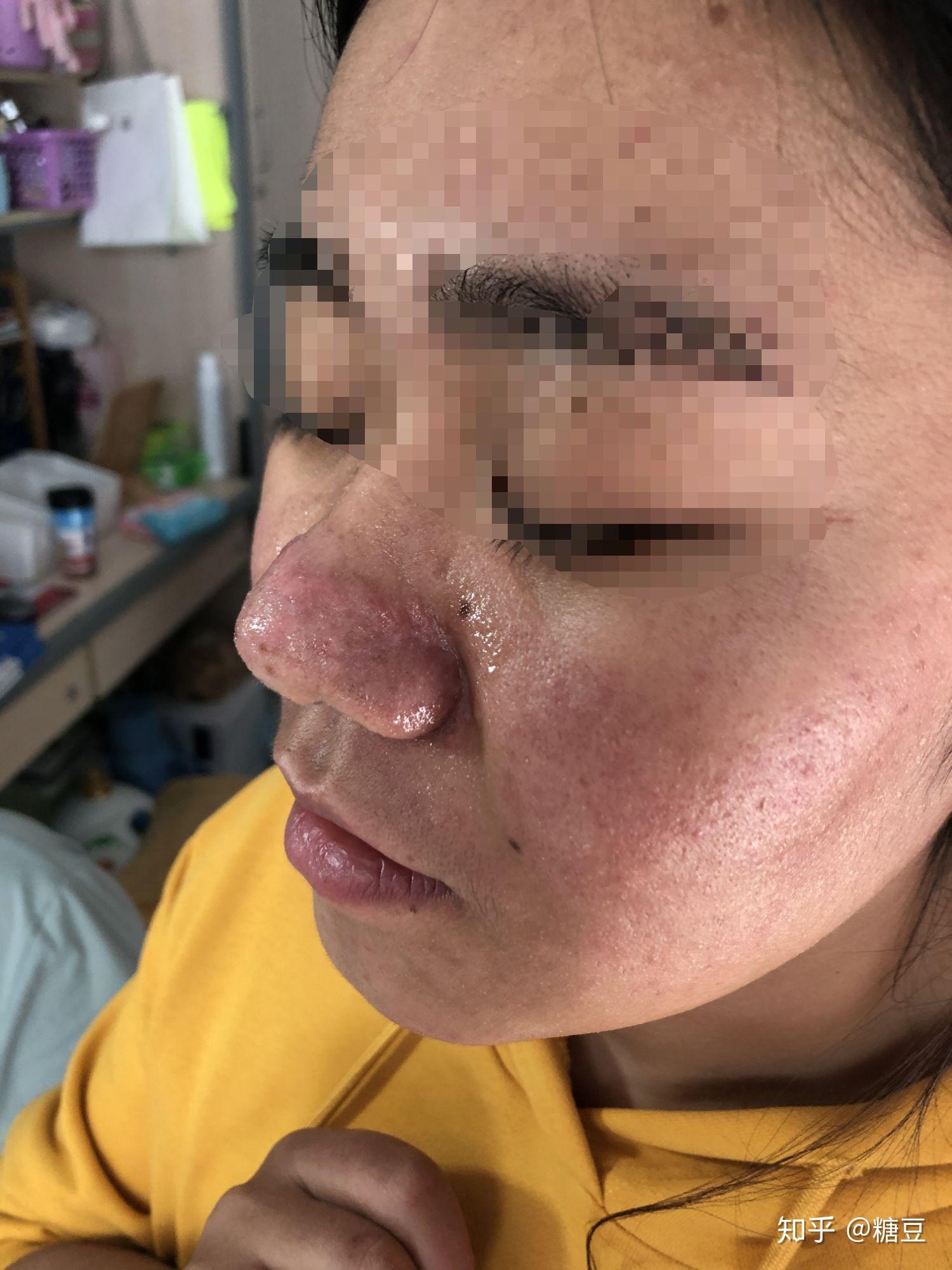 酒糟鼻点阵激光记录 - 知乎