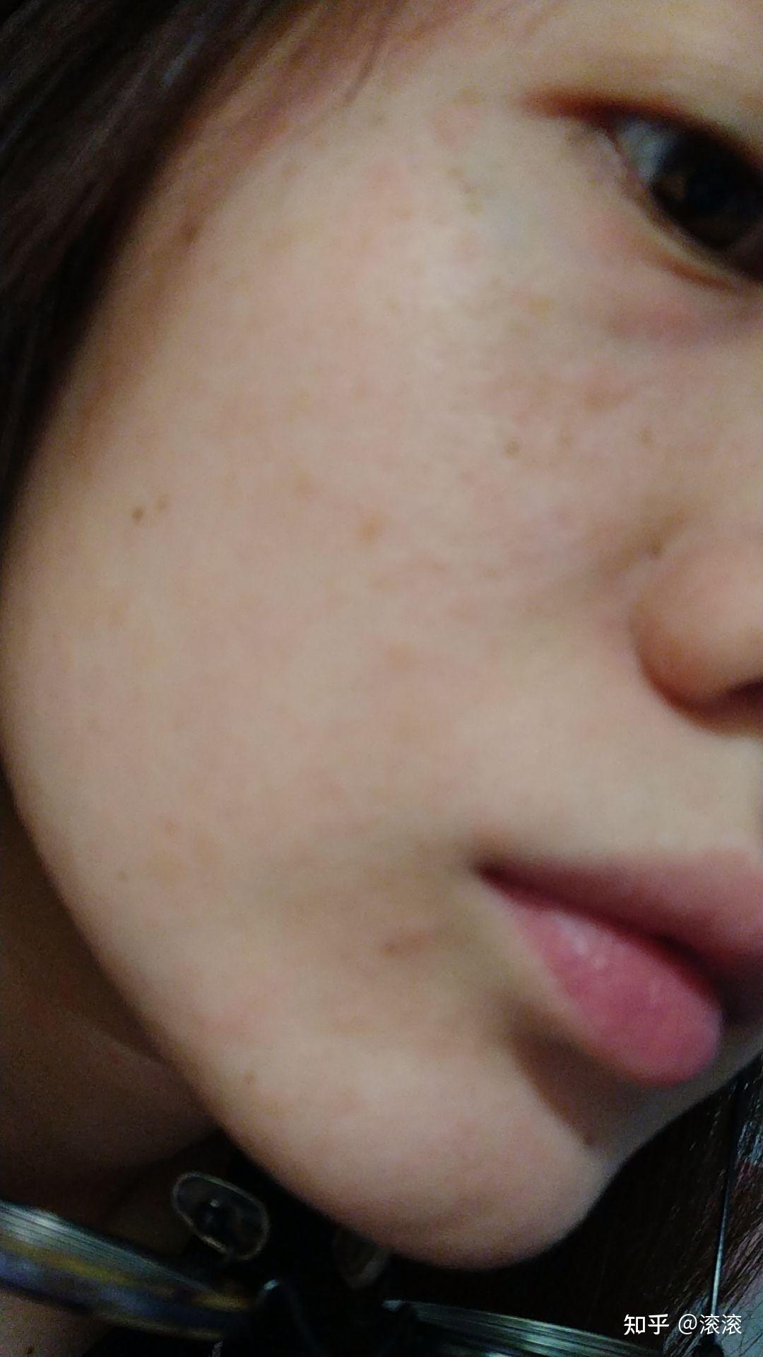 一个叫滚滚的女孩对抗玫瑰糠疹全记录持续更新直到好转