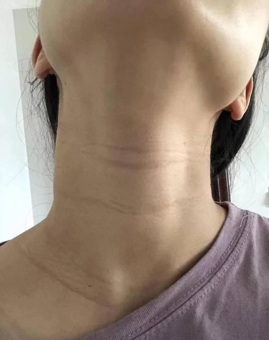 怎样才能去掉颈纹有颈纹的女生进分享一个月跟颈纹彻底说拜拜的经验