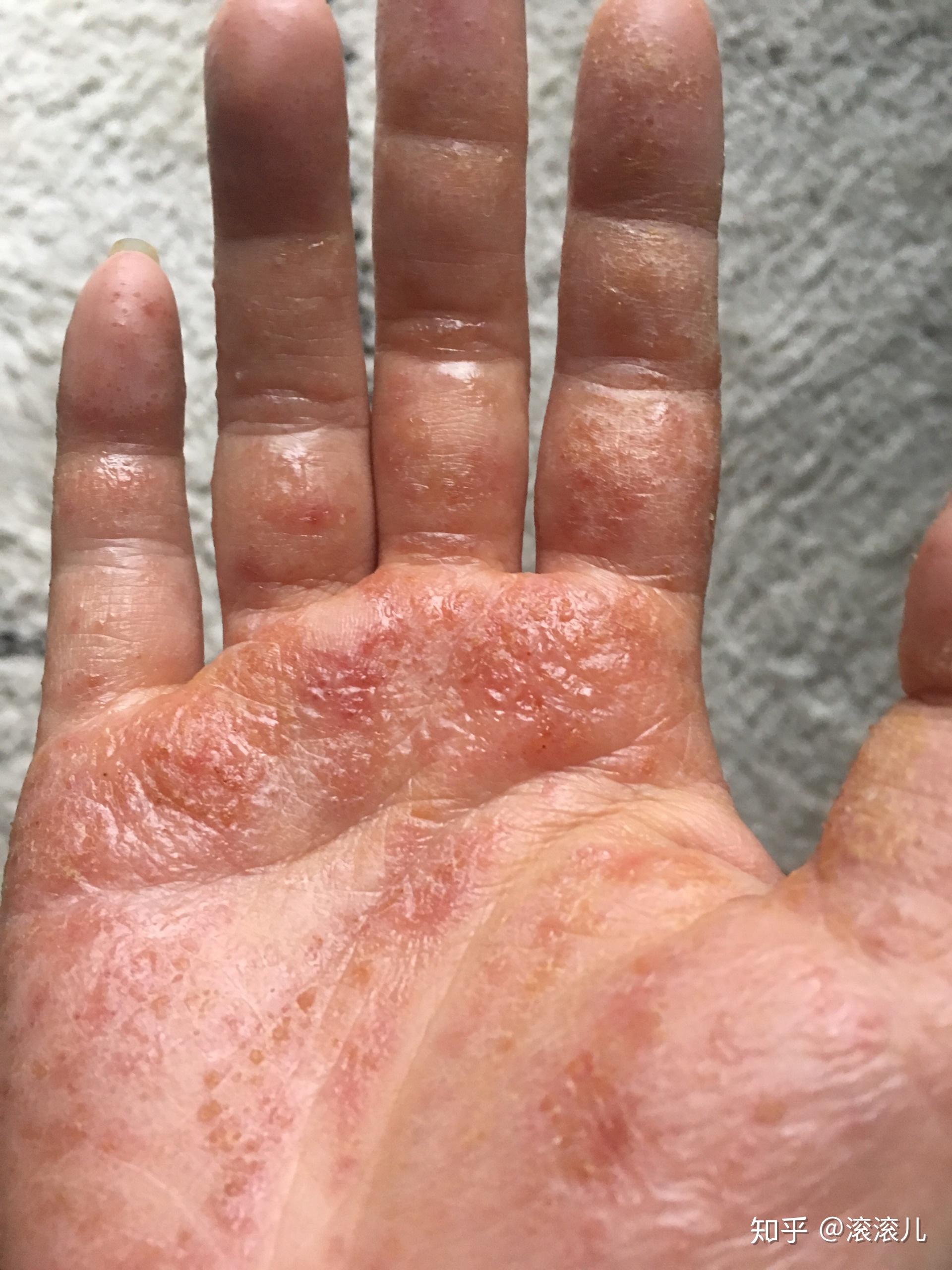 手部湿疹能根治吗