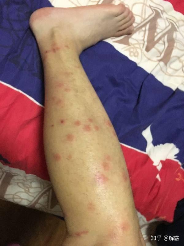 被老鼠身上的跳蚤咬了会得鼠疫吗