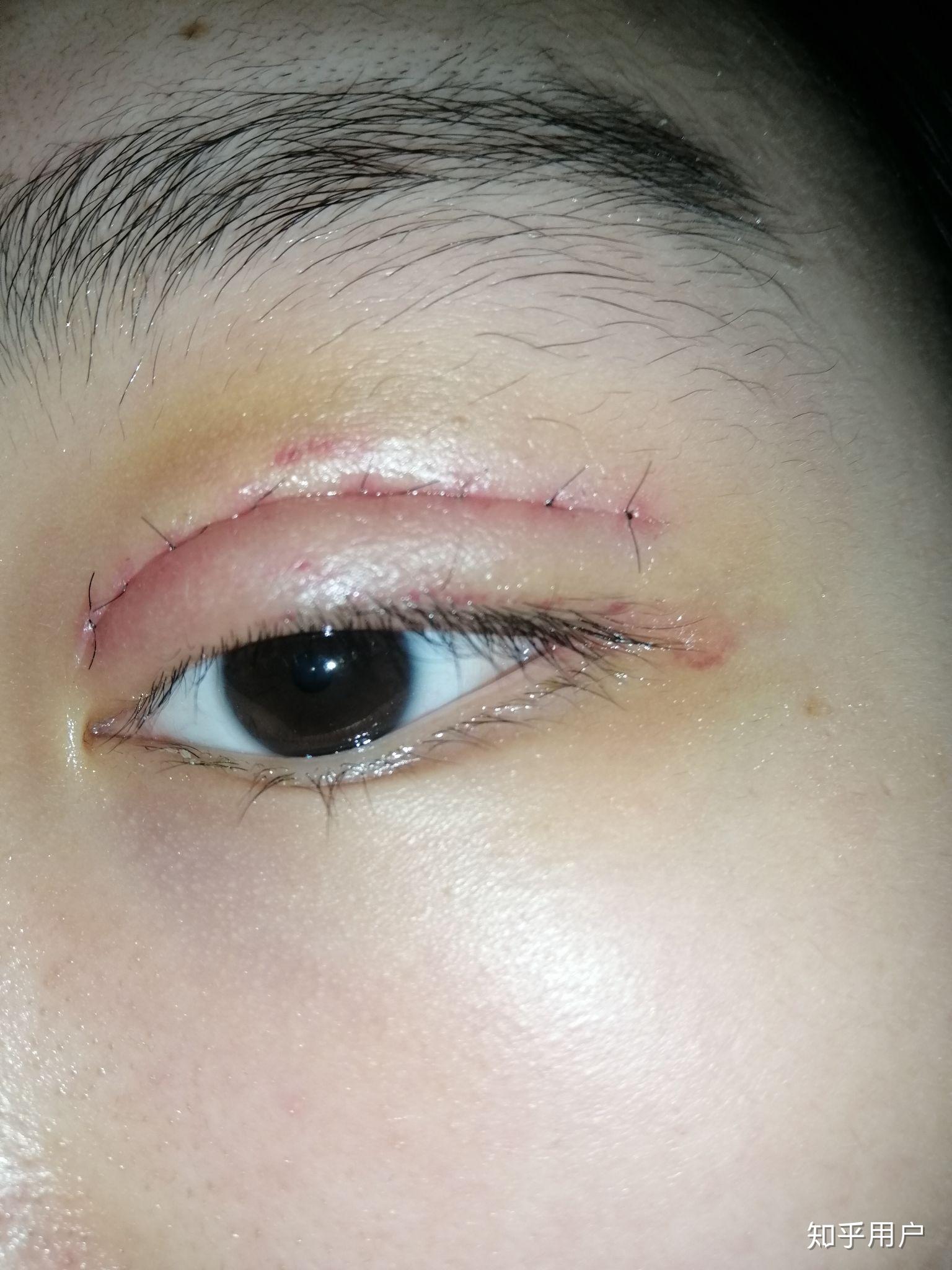 请问这是发炎吗 双眼皮术后21天了 一直在忌口? - 知乎