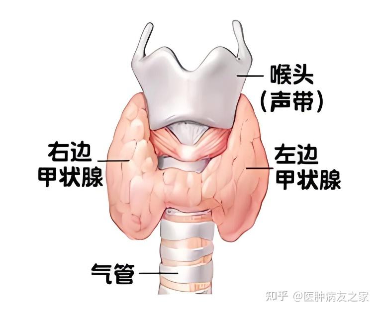 甲状腺癌11:甲状腺癌手术切口会在哪些部位?单侧切除还是双侧切除?