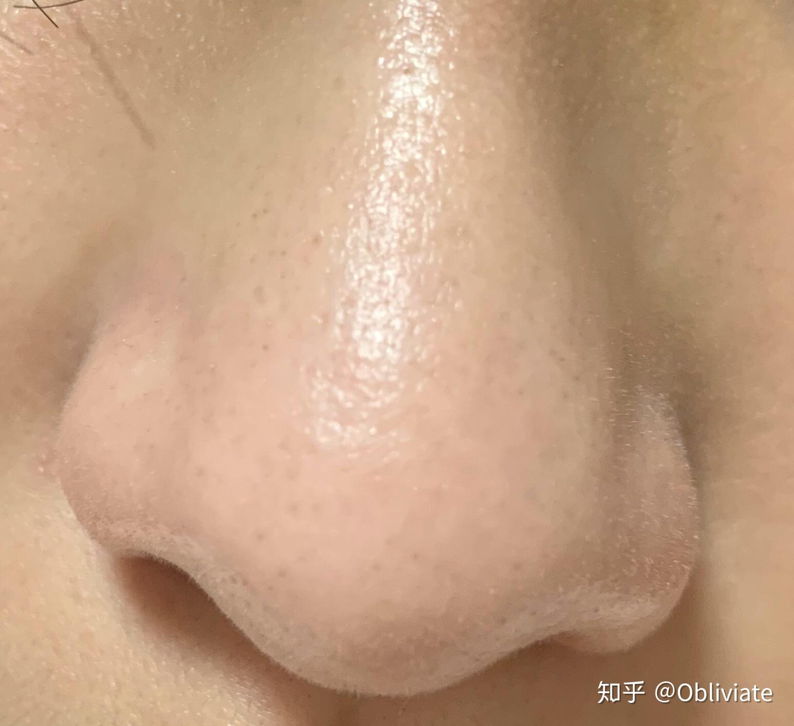 如何去除鼻子上的白头