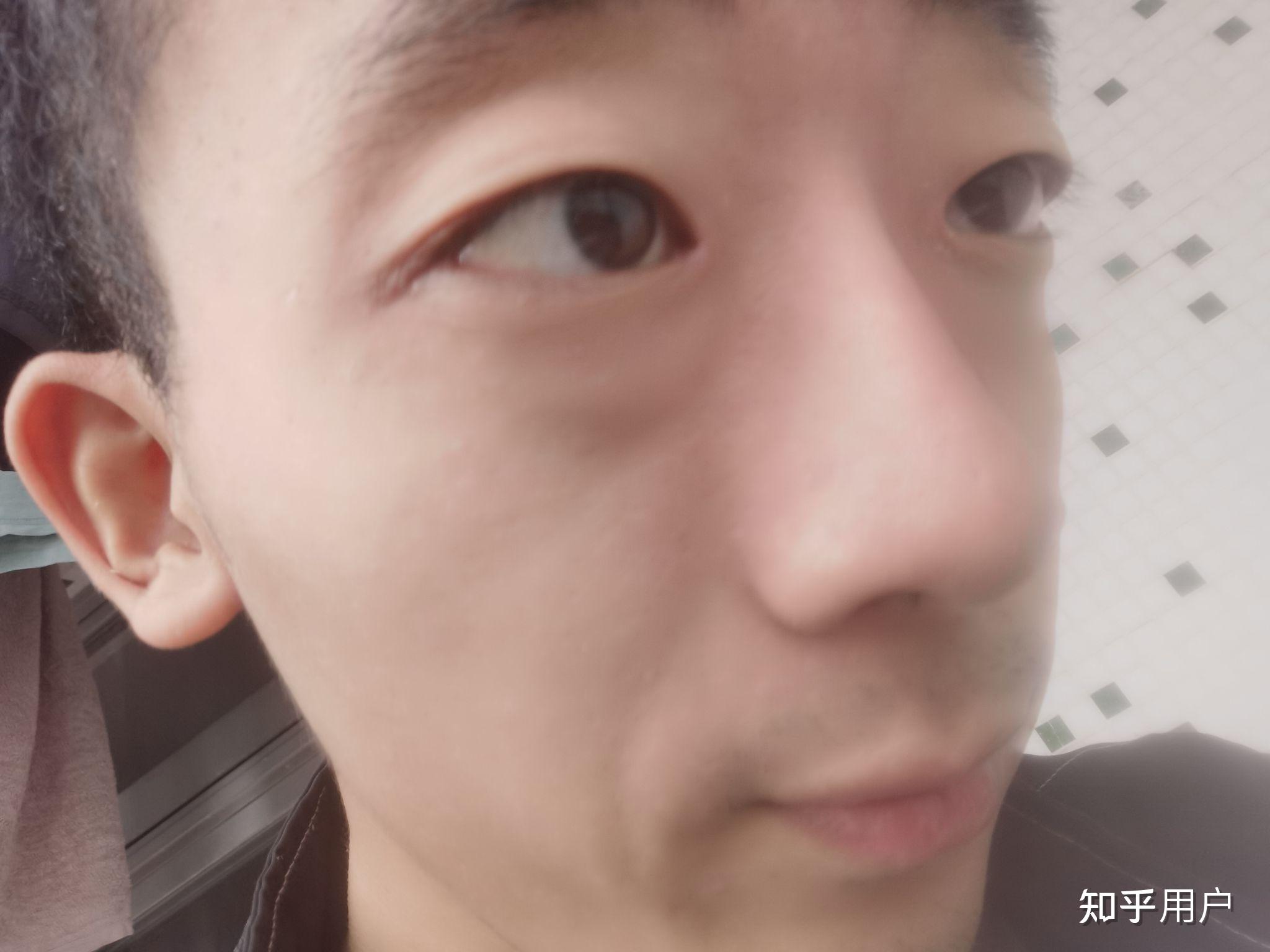 高度近视的人就一定眼睛凸出吗?