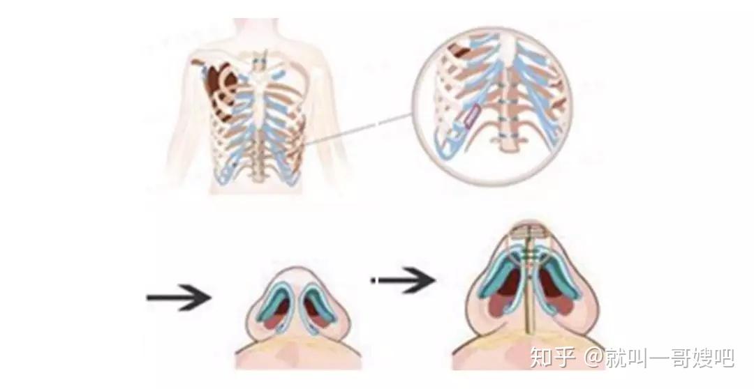 肋骨鼻放置图解图片