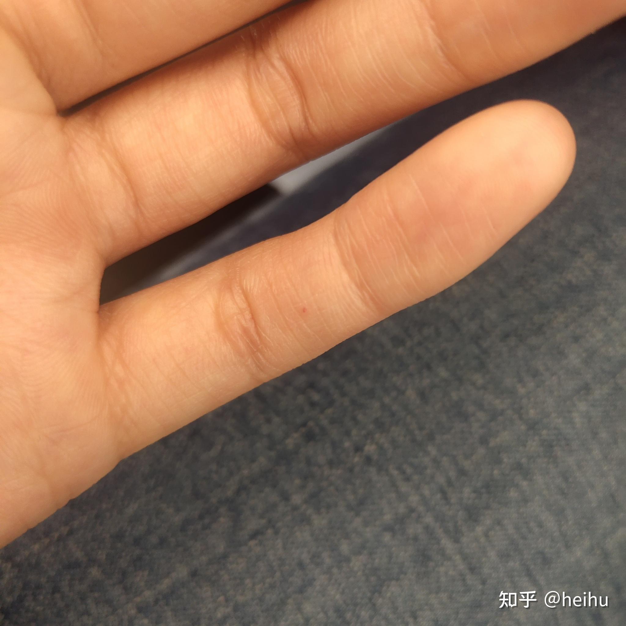 手指上长了一个针眼大的小红点 感觉像血管 一按就消失 松开就又出现