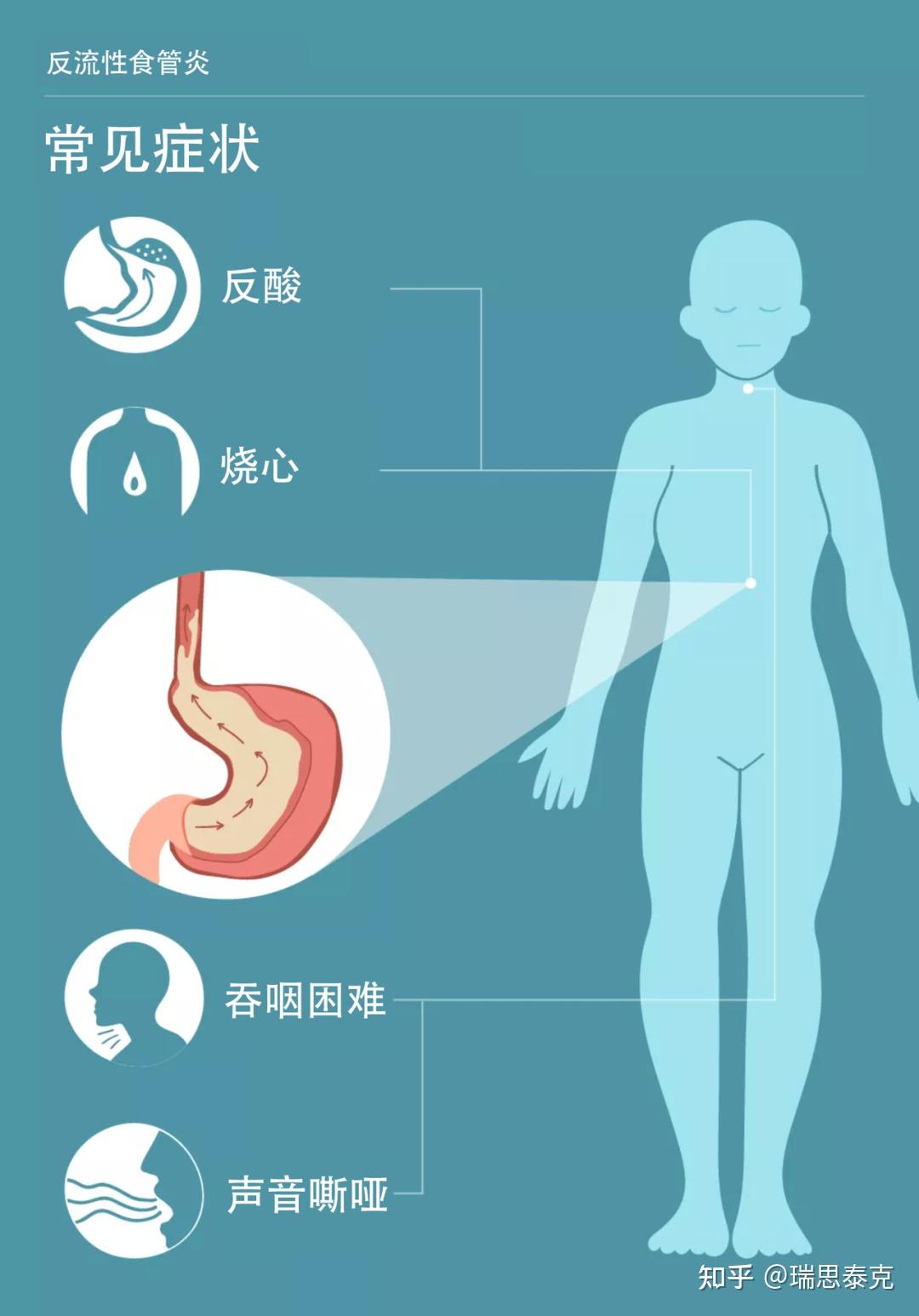 “反流性食管炎”——难言的“酸楚” - 知乎