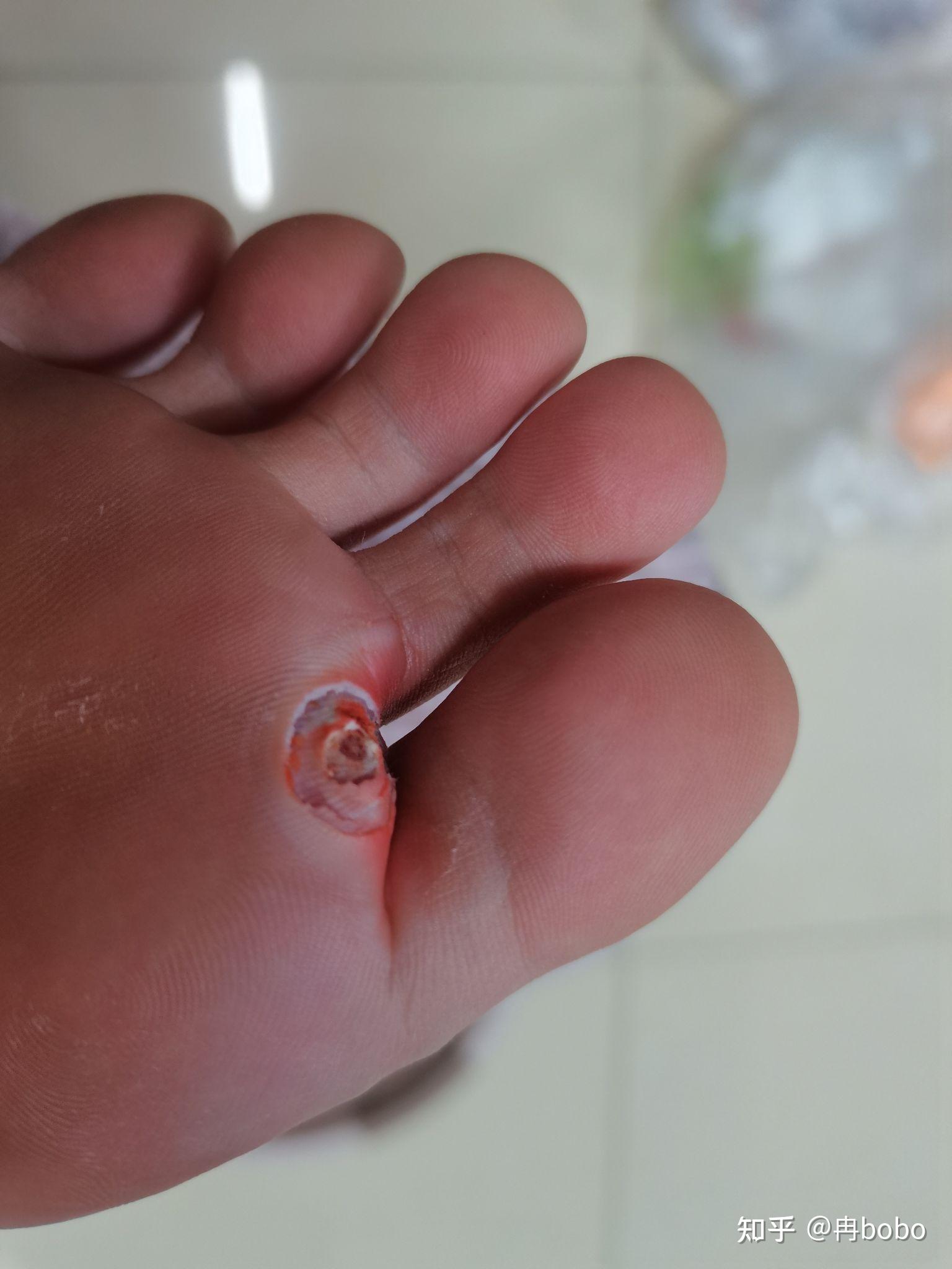 室友挖鸡眼是一种怎样的体验? - 知乎