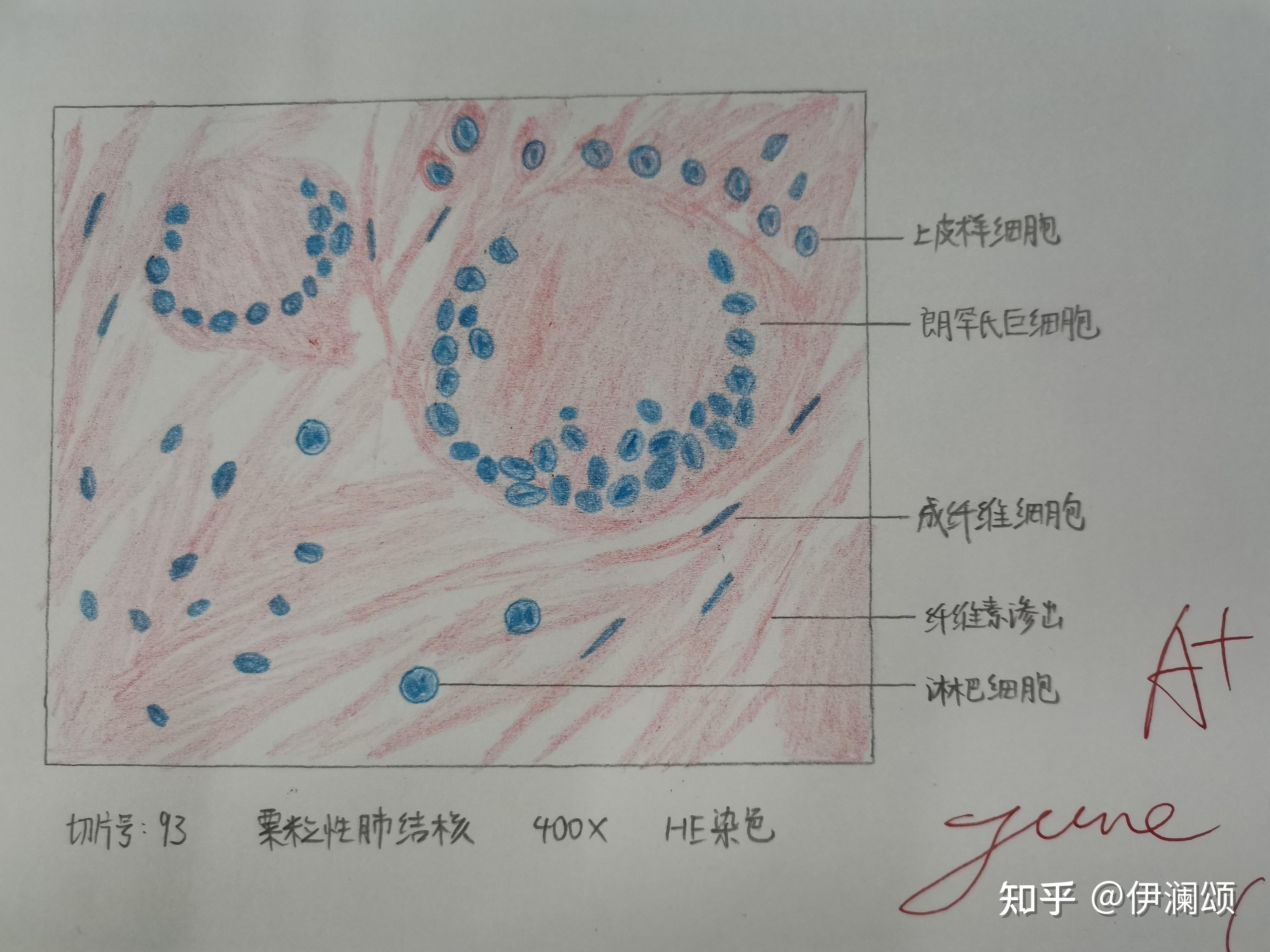 23,肠伤寒24,肝血吸虫病(这一张画完就交上去了,所以看不到评分,可能