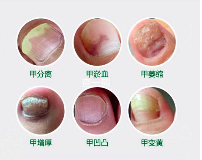 【灰指甲】灰指甲严重到甲萎缩,根除案例分享 - 知乎