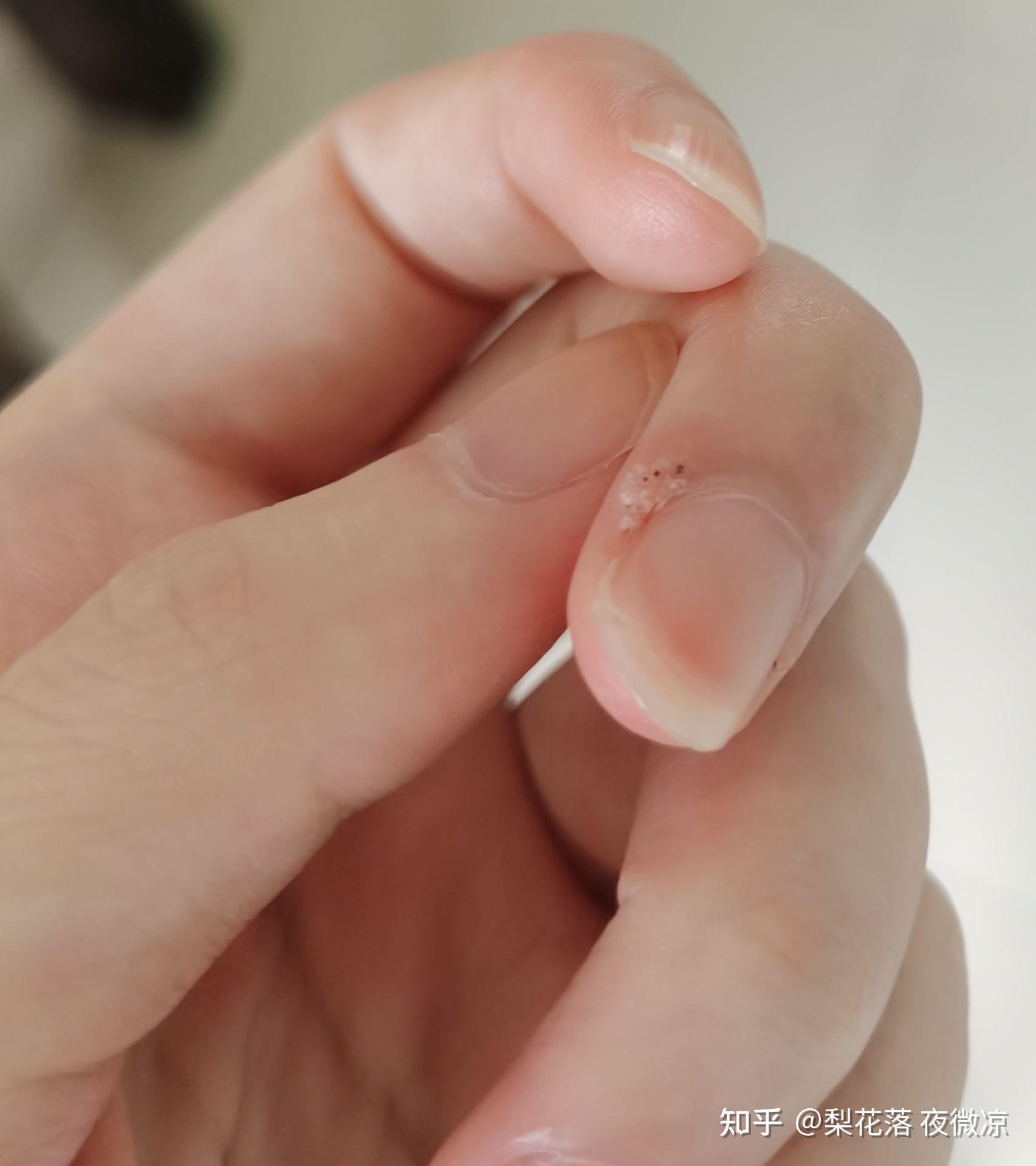 甲周疣治疗过程