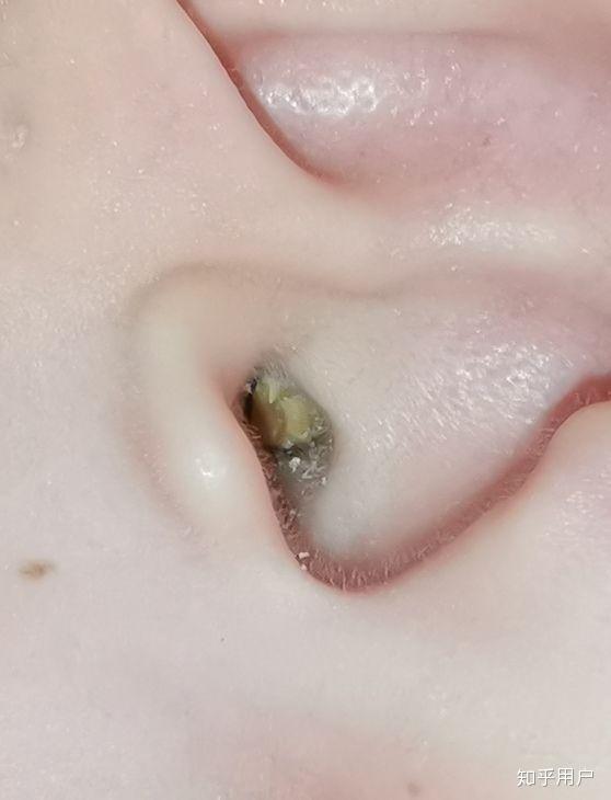 耳屎能大到什么程度? - 知乎