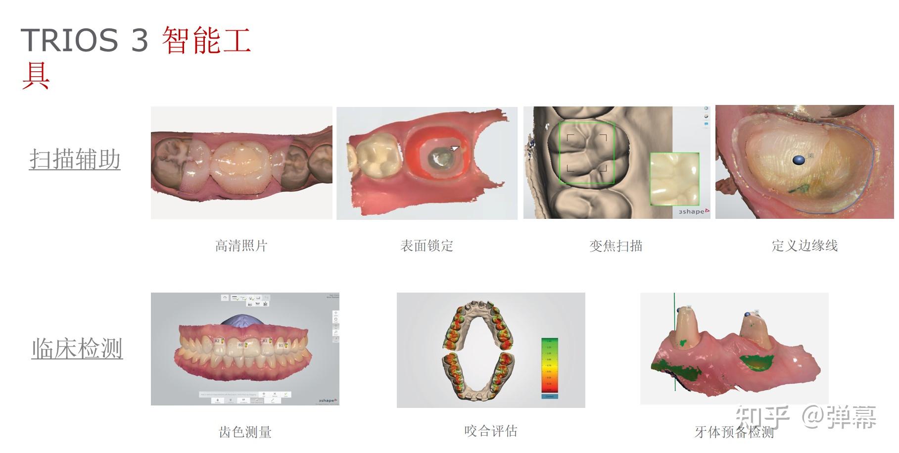 3shape口扫取模和传统取模的区别是什么?优势是什么? - 知乎