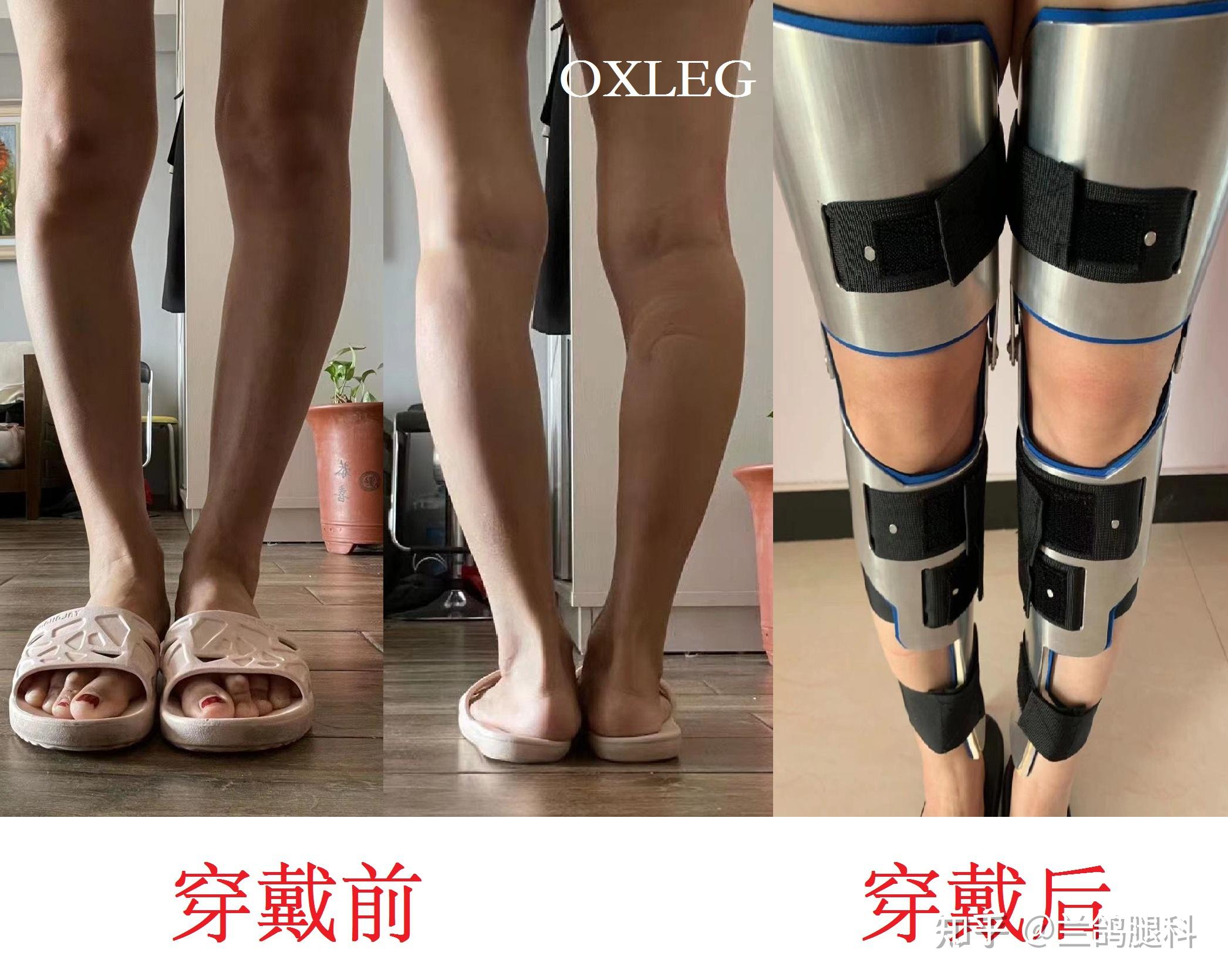 康复医学科丨还我一双美腿——综合消肿疗法的开展 - 科室新闻 - 欢迎光临安徽省第二人民医院