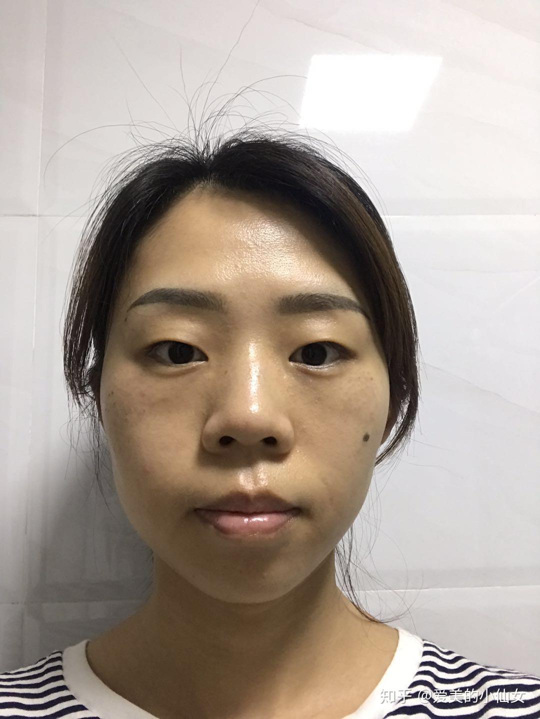 做了双皮秒后从黄脸婆变身少女了