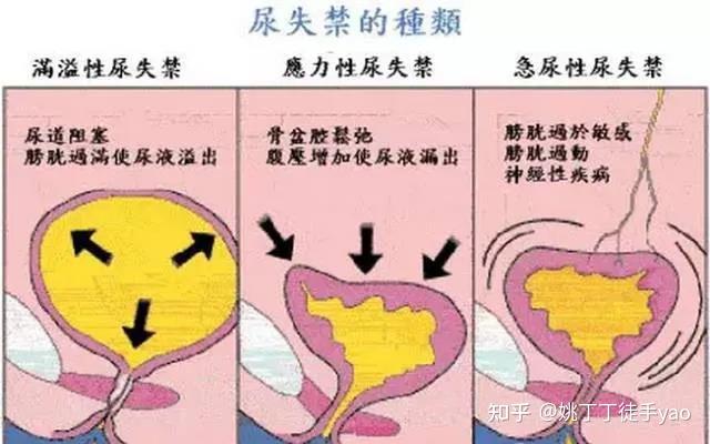 盆底肌之尿失禁压力性尿失禁漏尿