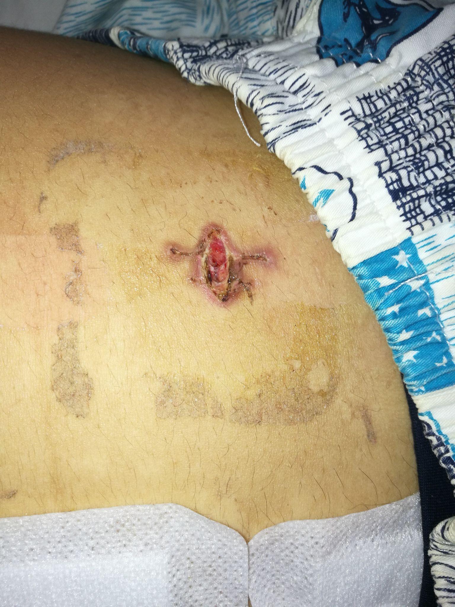 做微创阑尾炎手术是一种什么体验