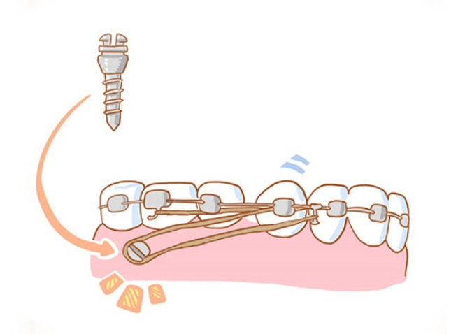 什么情况下需要打骨钉