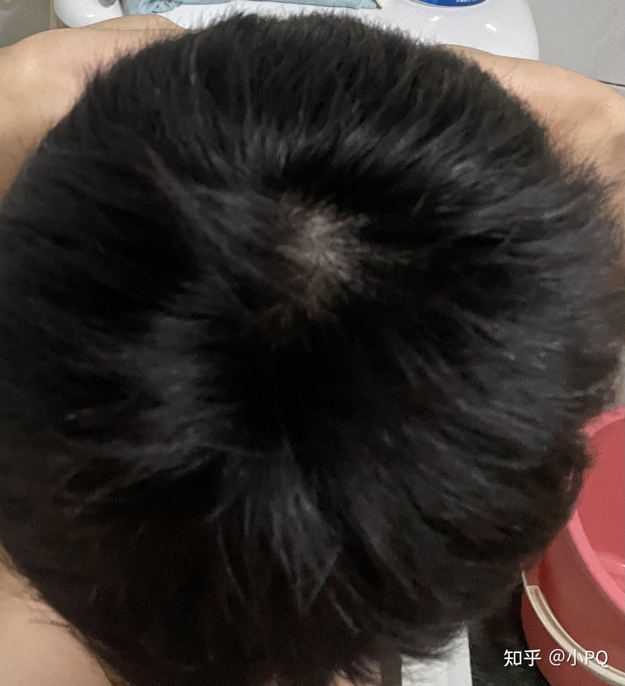 我这头顶漩涡处头发量正常吗? - 知乎