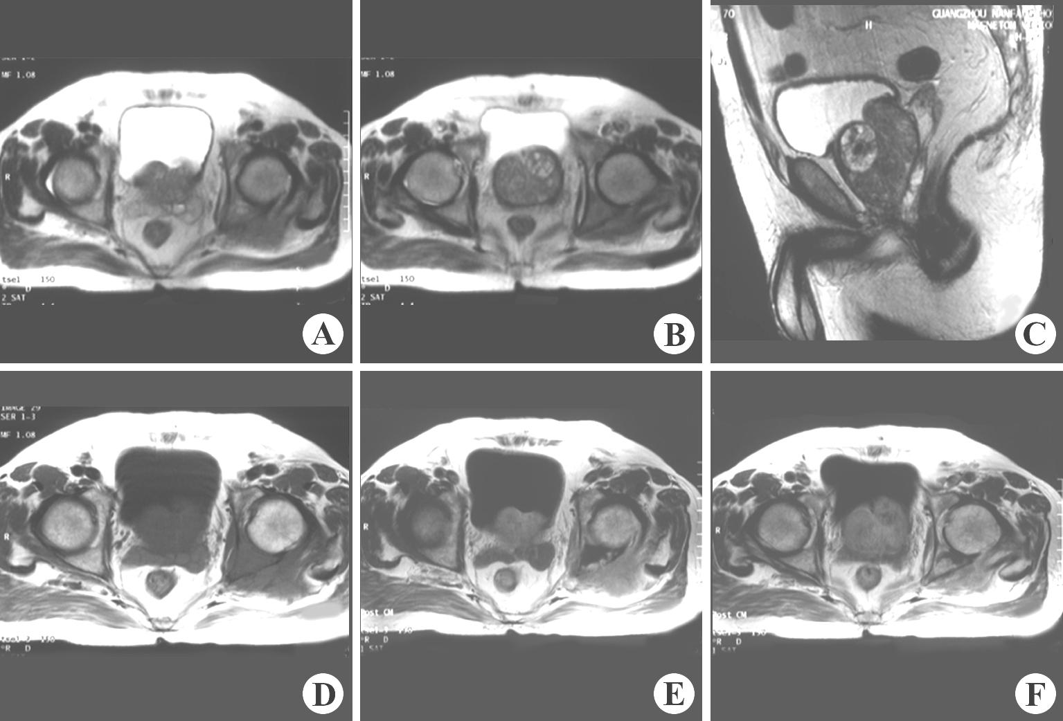 前列腺钙化-腹部影像-图片