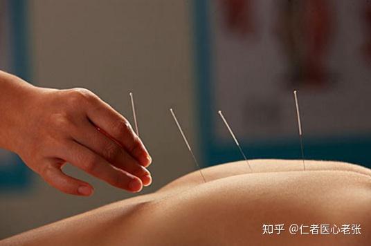 你所不知道的针灸治疗颈椎病的神奇效果 知乎