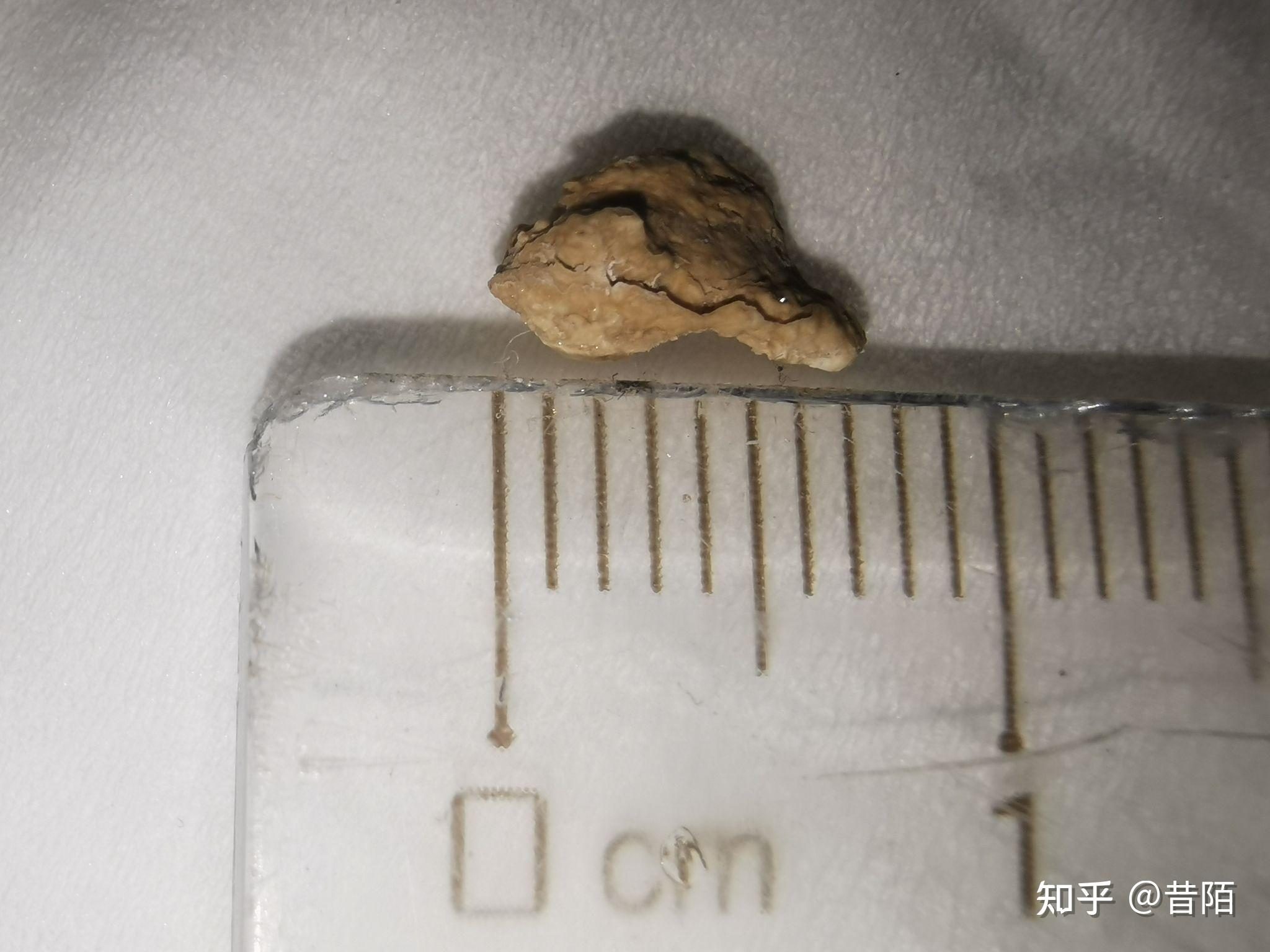 肾结石7毫米可以排出不