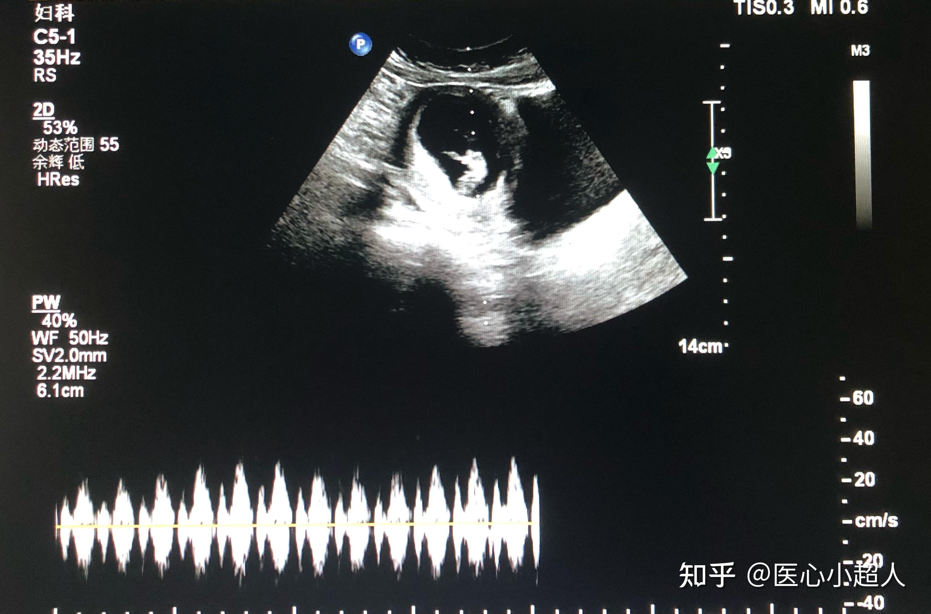 正常早期妊娠子宫超声所见（二） - 知乎