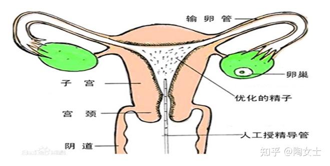 人工授精步骤图解图片