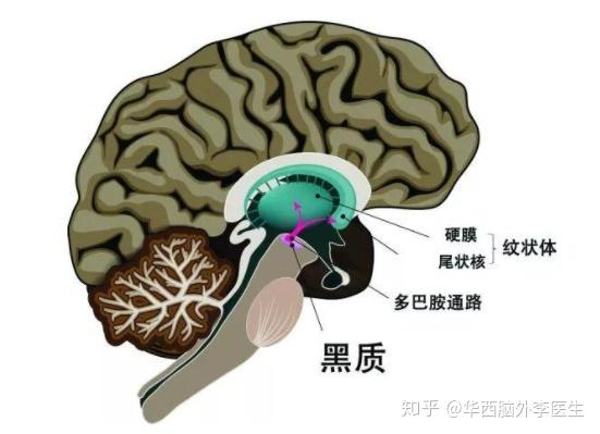 帕金森综合征是由什么原因引起呢? - 知乎