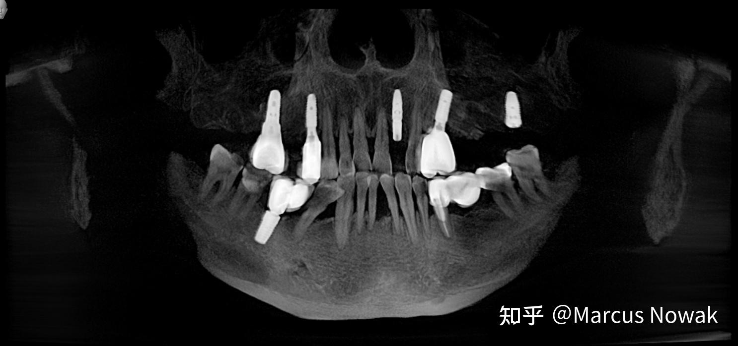 極簡一站式口腔為什麼要拍x線片