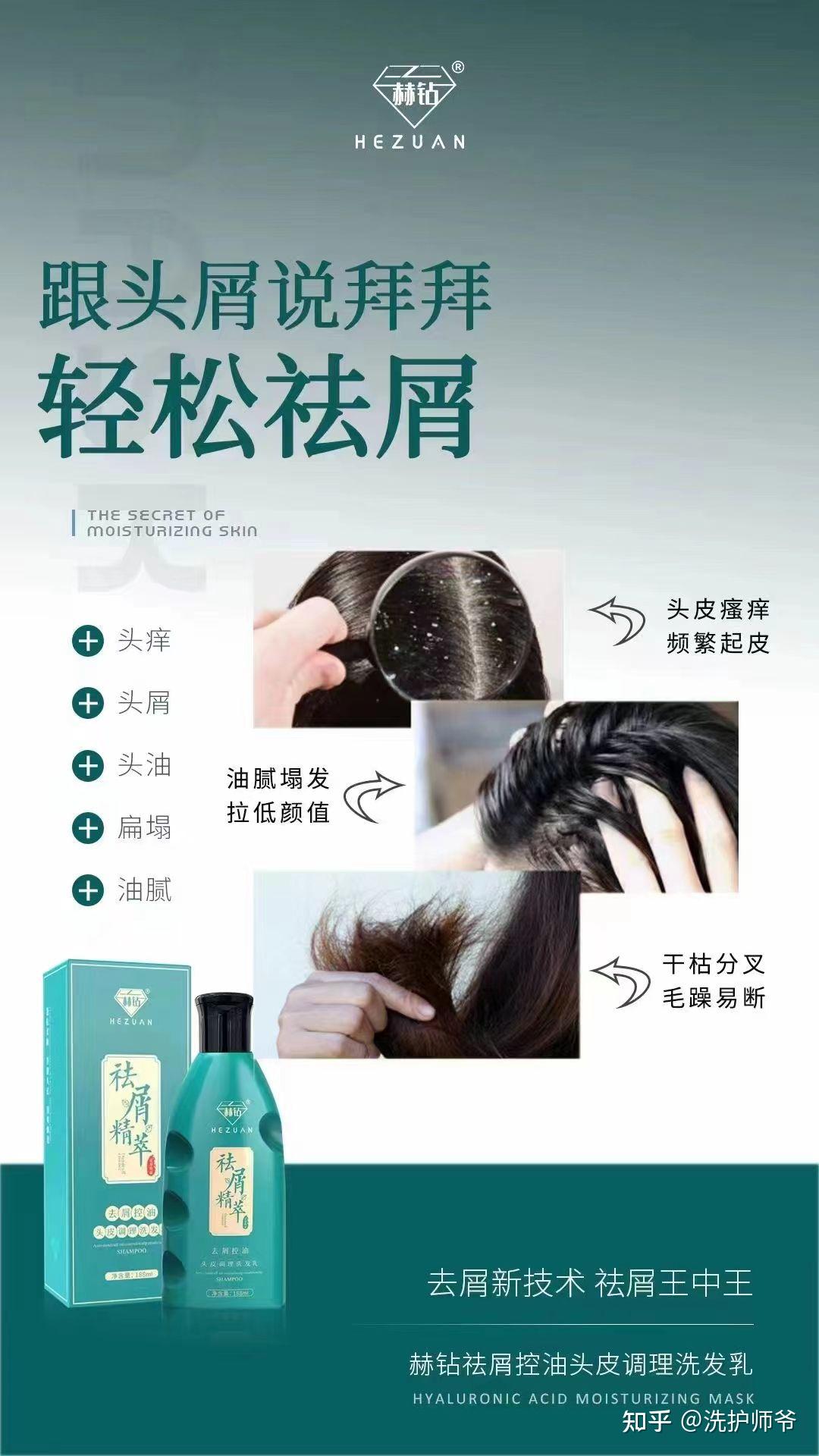 怎么去头屑最快最有效的方法去屑止痒哪个品牌好 - 知乎