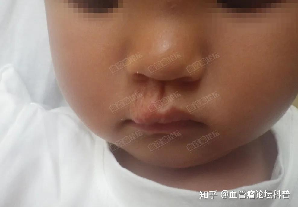 孩子唇部长有巨大的血管瘤，应该如何治疗？