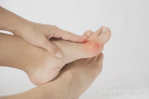 拇外翻并发拇囊炎是什么情况？ - 知乎