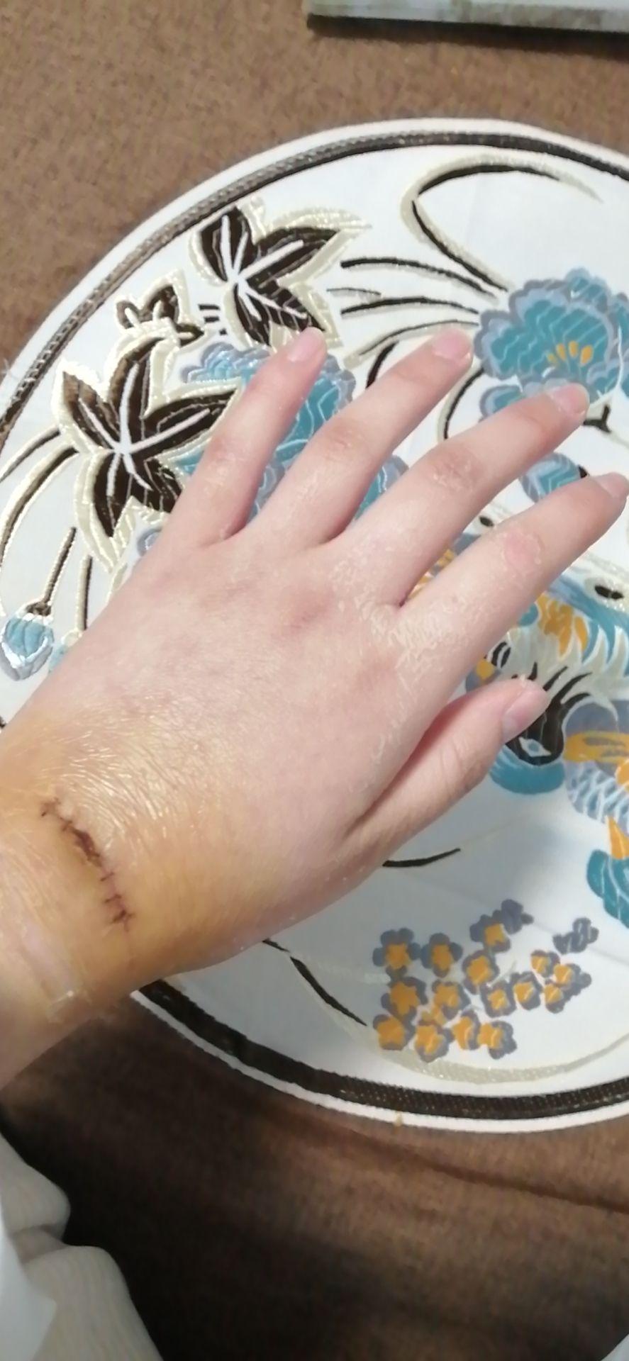 腱鞘囊肿手术之后多久能恢复? - 知乎