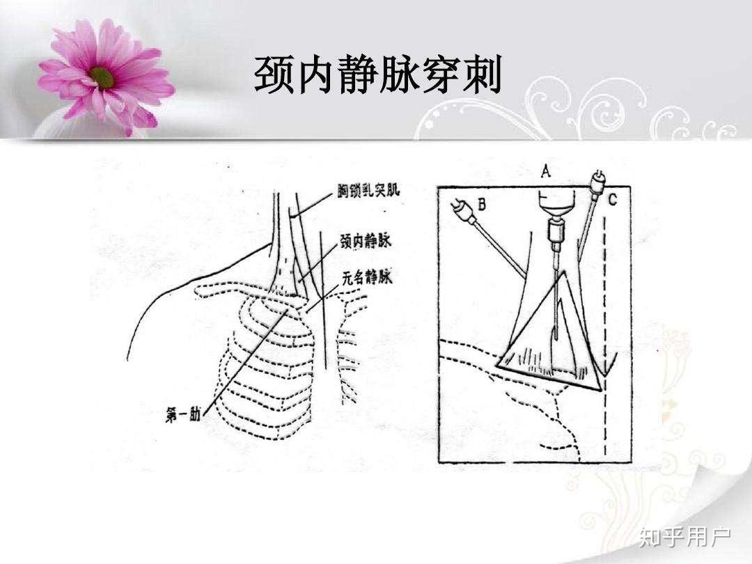 颈静脉穿刺技巧