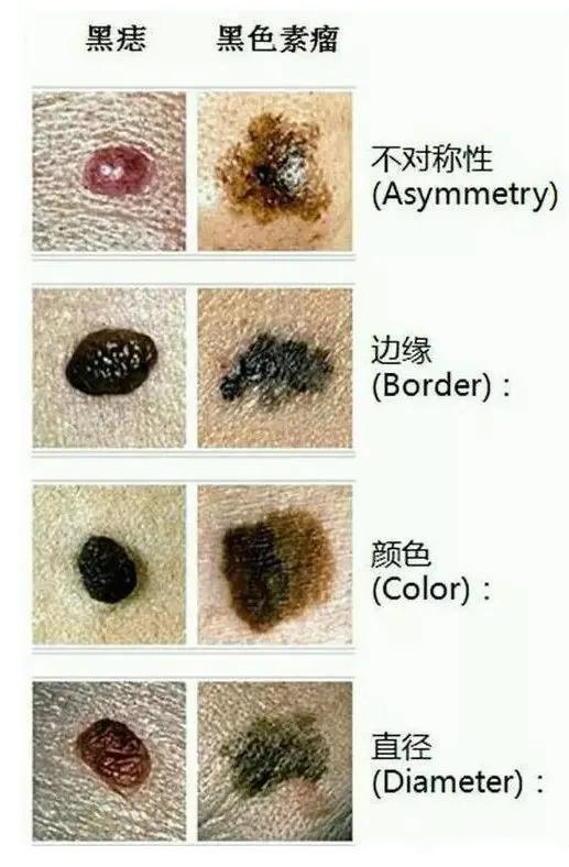 我的痣该祛除吗痣的诊断和切除