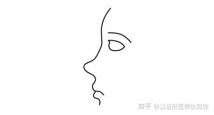 鞍鼻形成的原因都有哪些