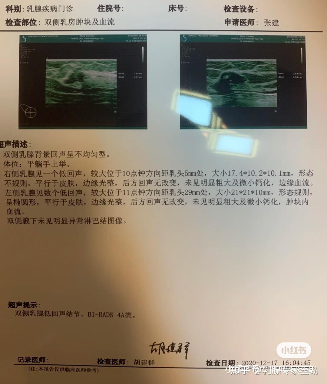 做b超檢查發現乳腺結節4a類,做了穿刺活檢是良性,醫生建議她立刻手術