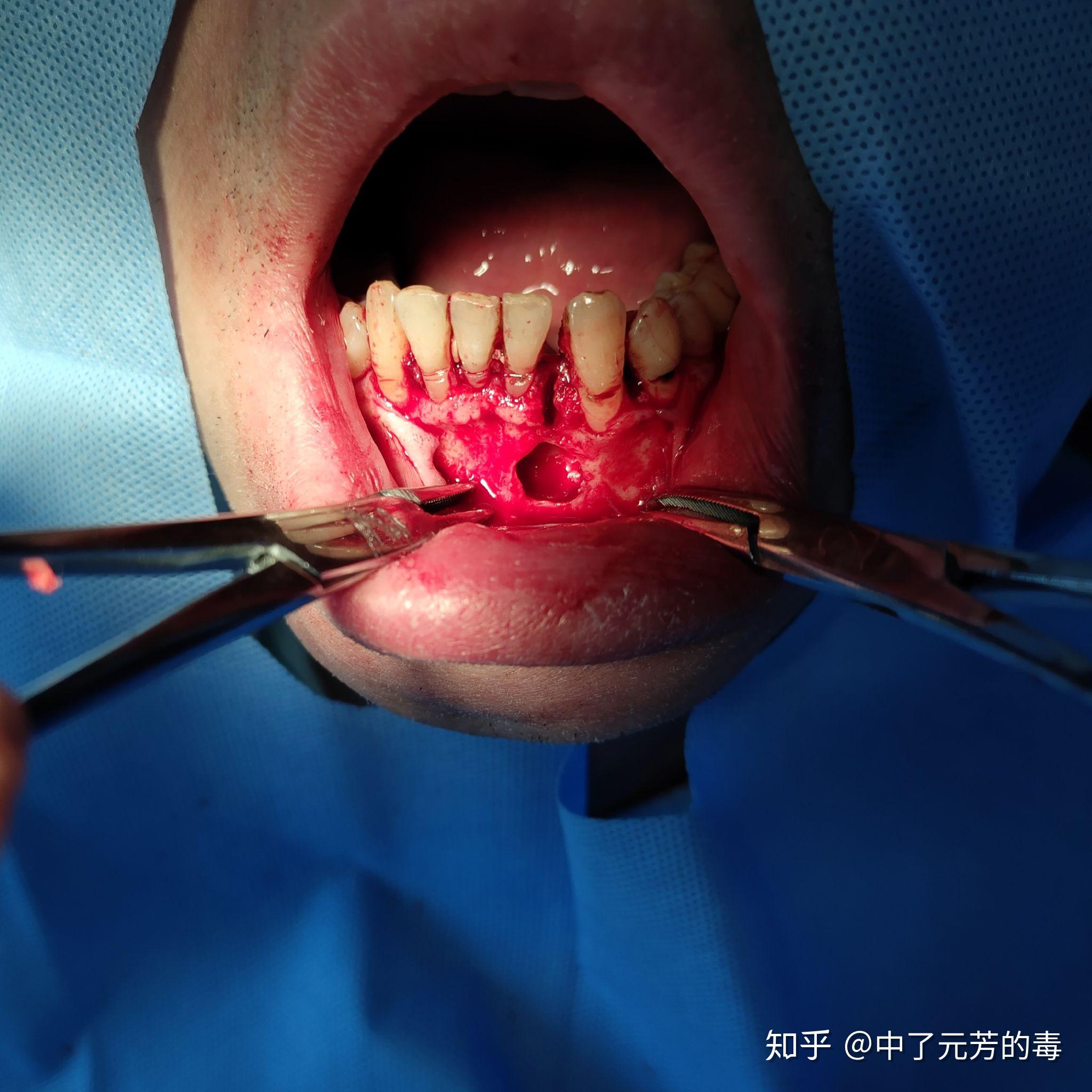 下颌骨囊肿,治疗方法和医院? - 知乎