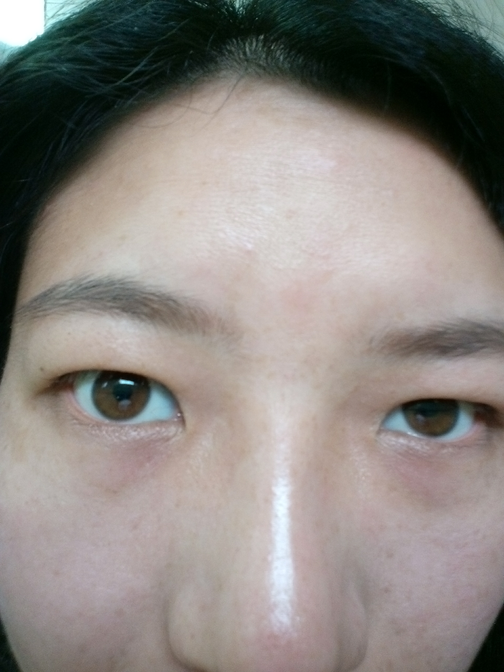 年前做的激光,现在想割双眼皮有什么危害? - b