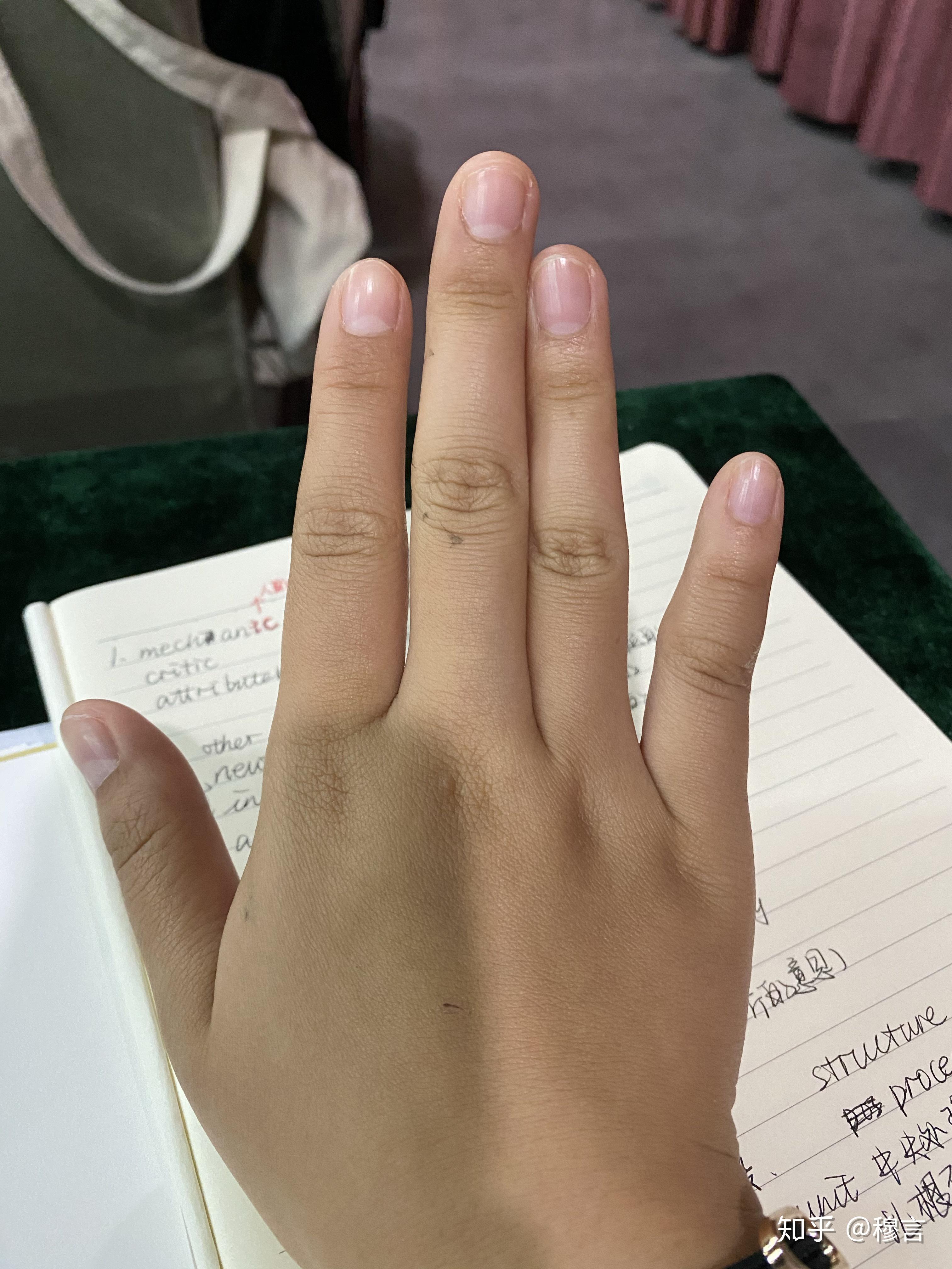 这是手指歪了嘛?能否矫正? - 知乎