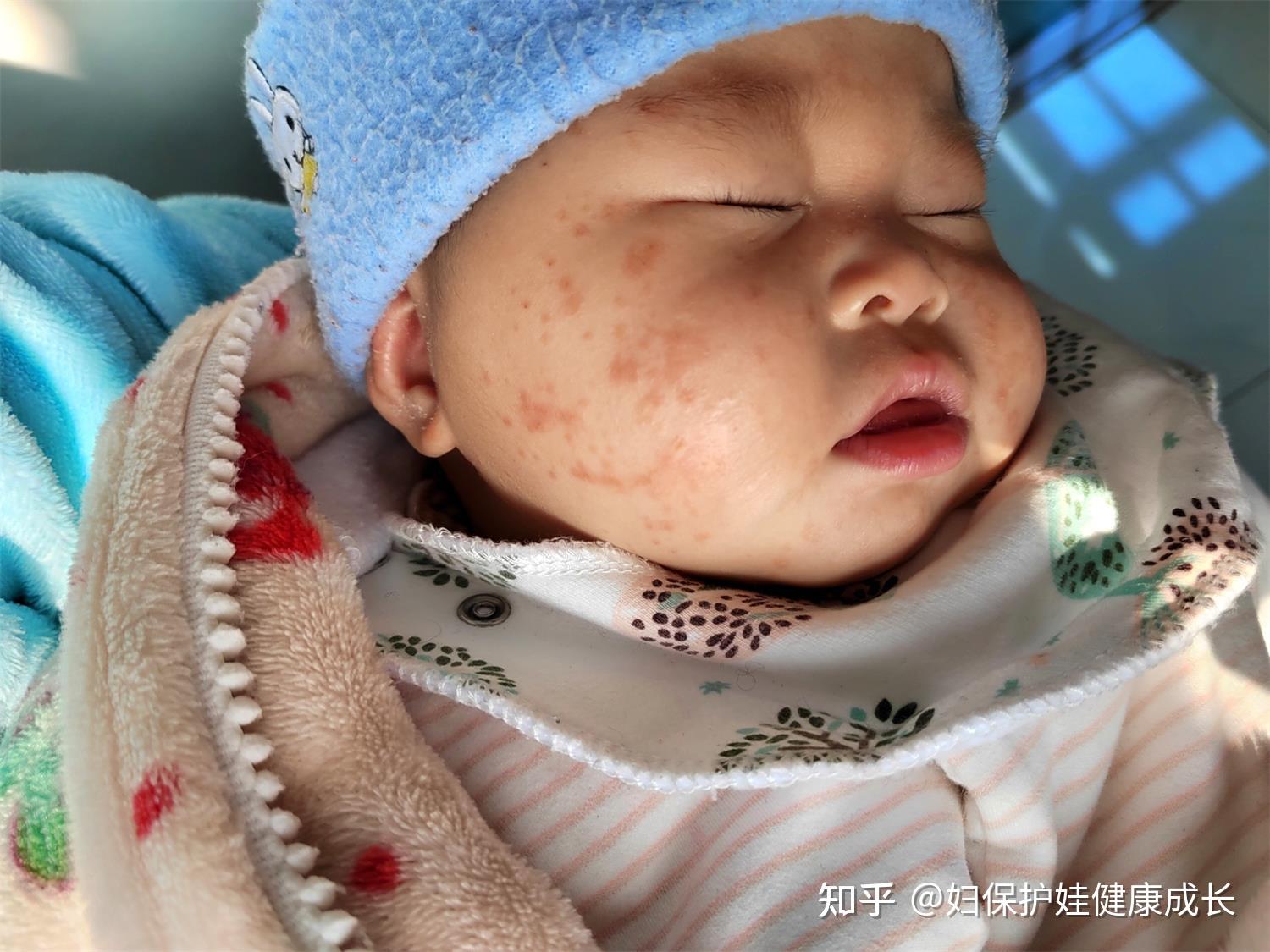 如何辨别新生儿奶癣和湿疹的区别图片（果来米麻麻 奶癣和湿疹有区别吗？到底该如何防止呢？我来教你） | 说明书网