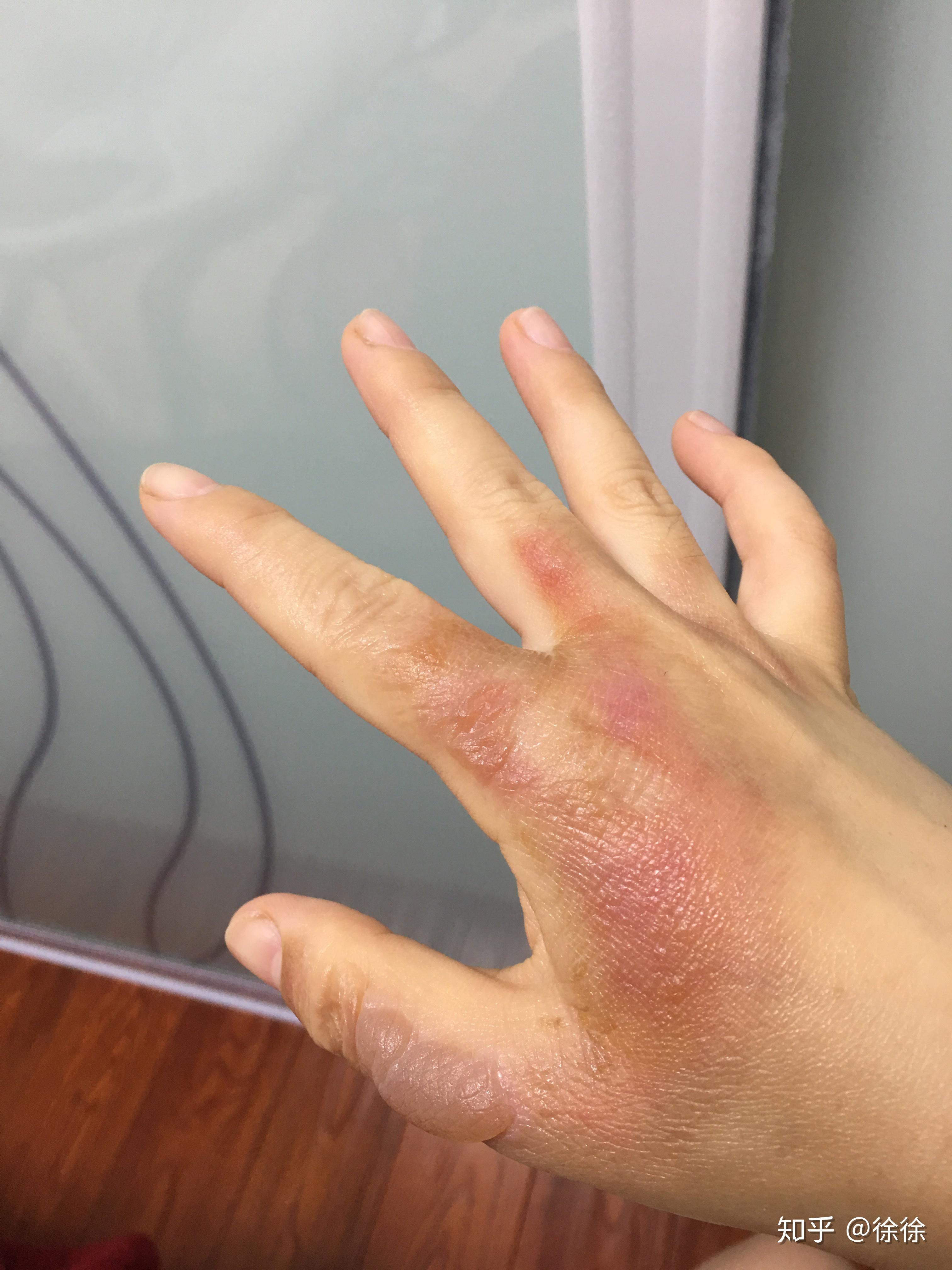 烫伤起的水泡可以戳破吗? - 知乎