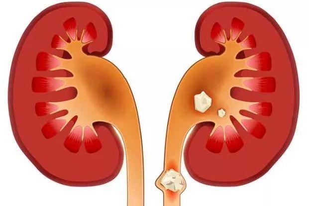 肾结石排石有几个阶段这几步你一定不了解