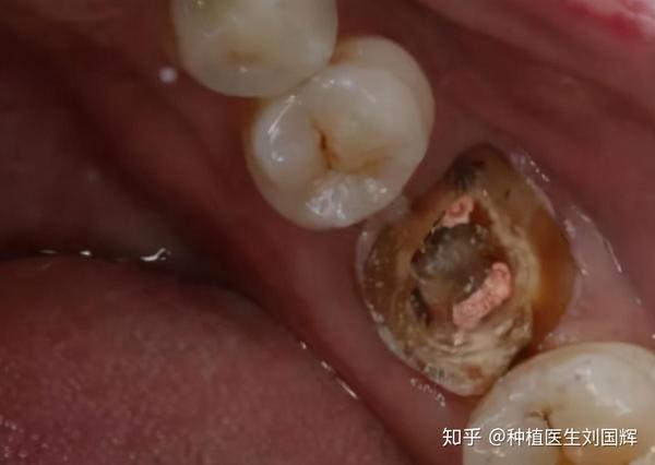 牙齿残根究竟要不要拔?怎么处理影响是最小的? - 知乎