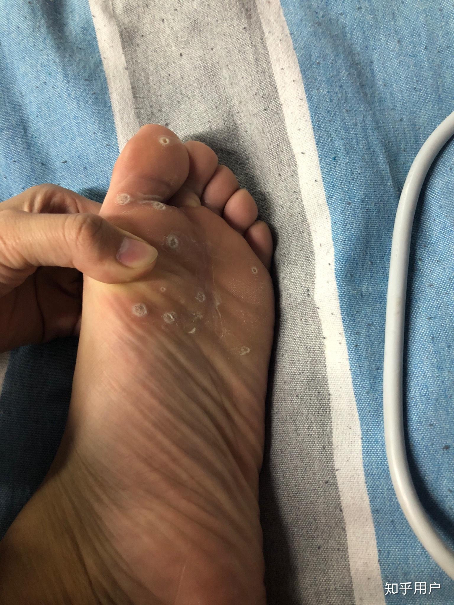 跖疣的自愈性大吗